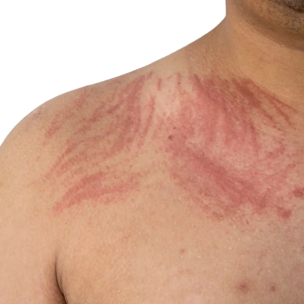 ALLERGY TREATMENT