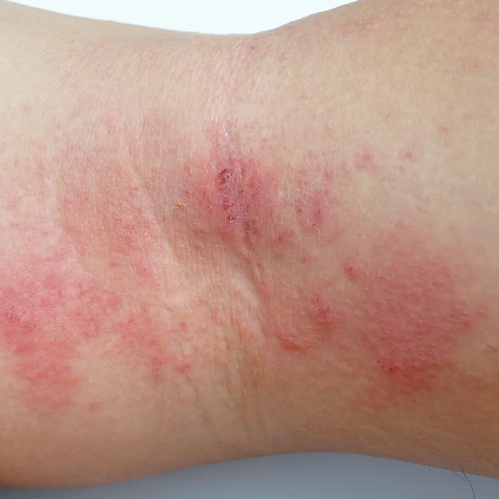 ALLERGY TREATMENT