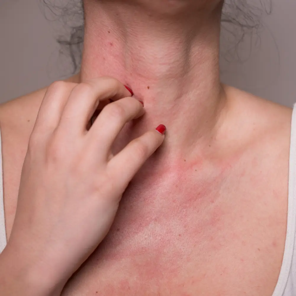 ALLERGY