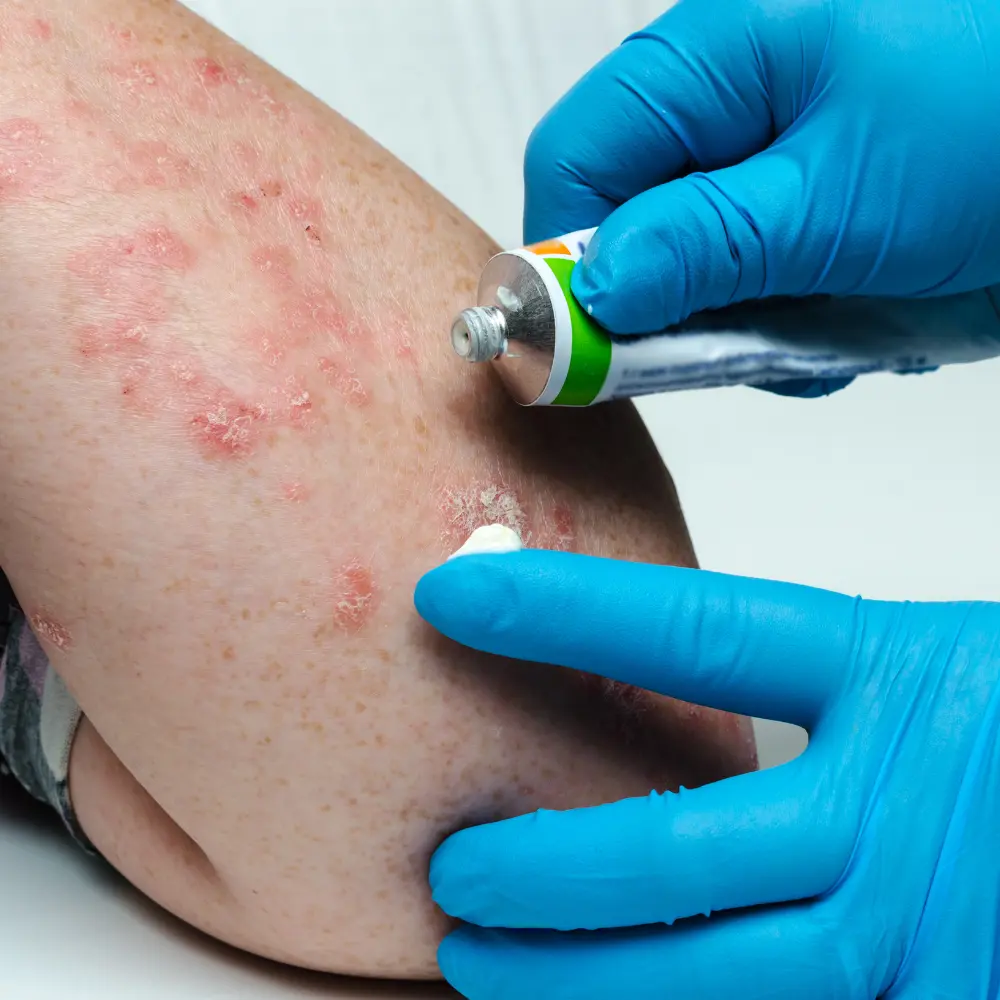 ALLERGY TREATMENT