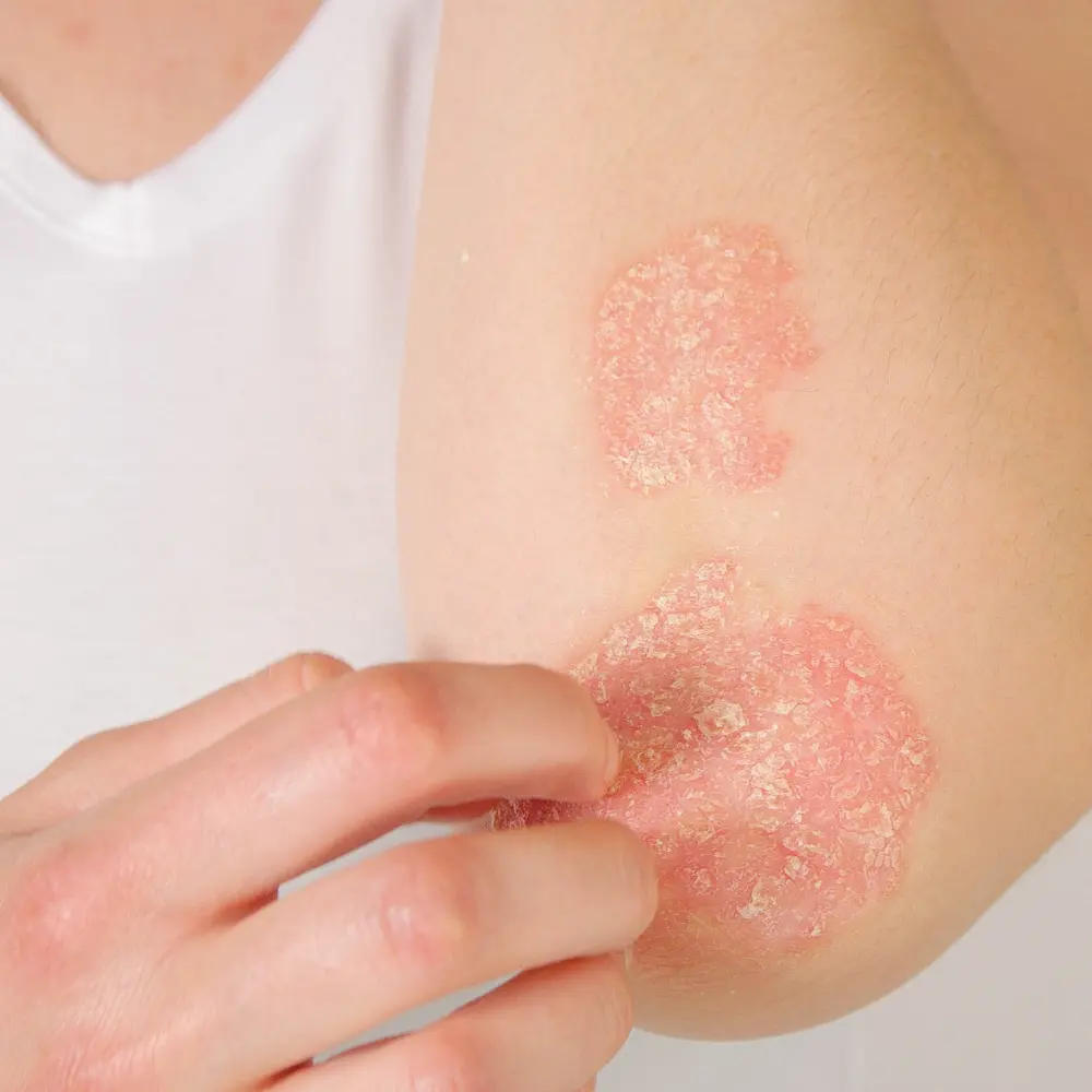 ALLERGY TREATMENT