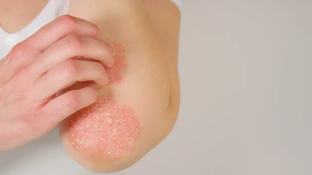 Eczema treatment