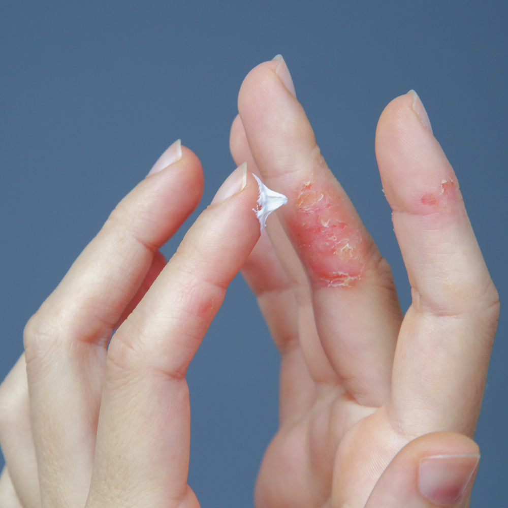 Eczema treatment