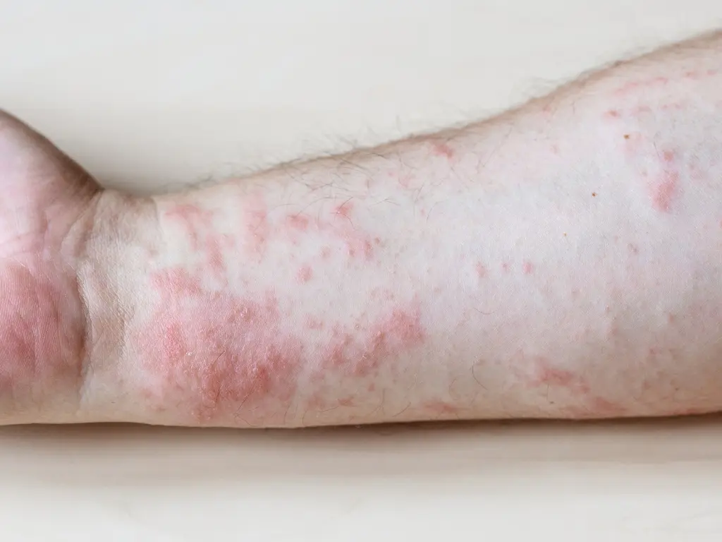 Eczema
