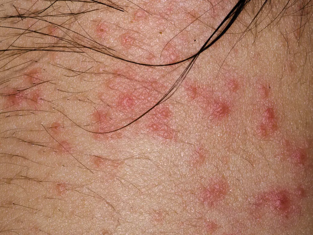 Eczema treatment