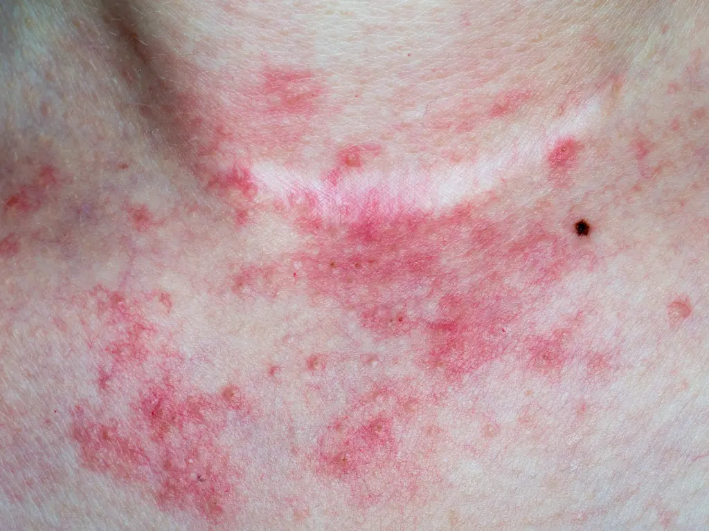 Eczema treatment