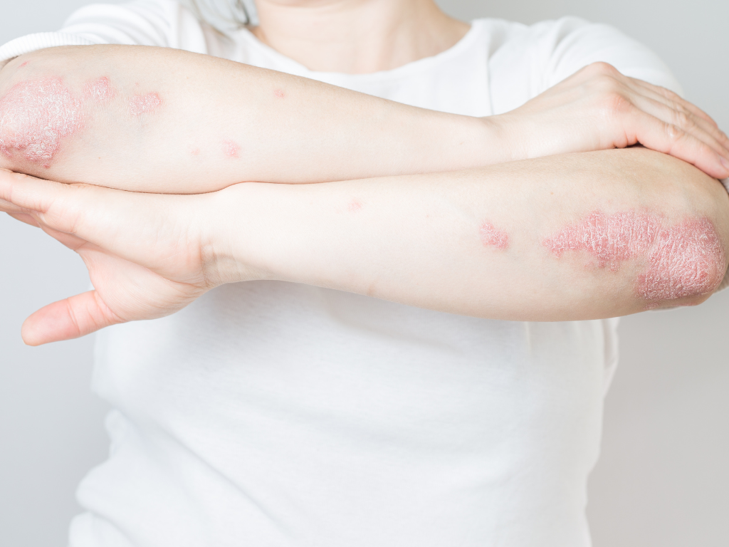 Eczema treatment