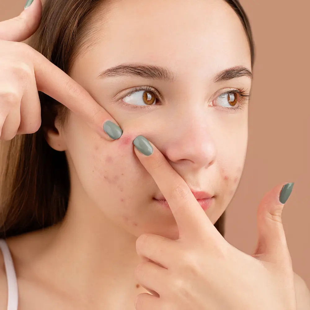 Skin pimles