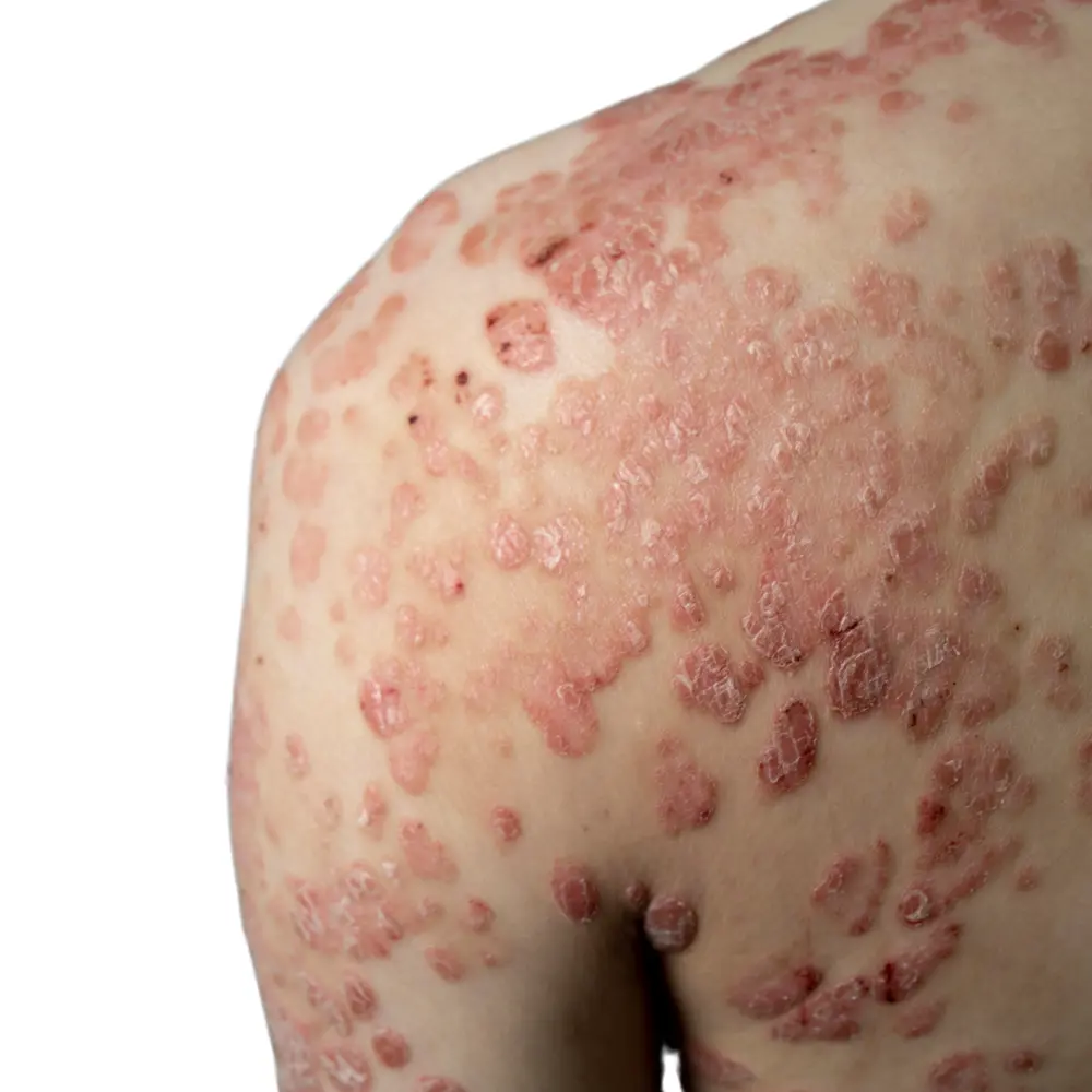 Psoriasis Treatment