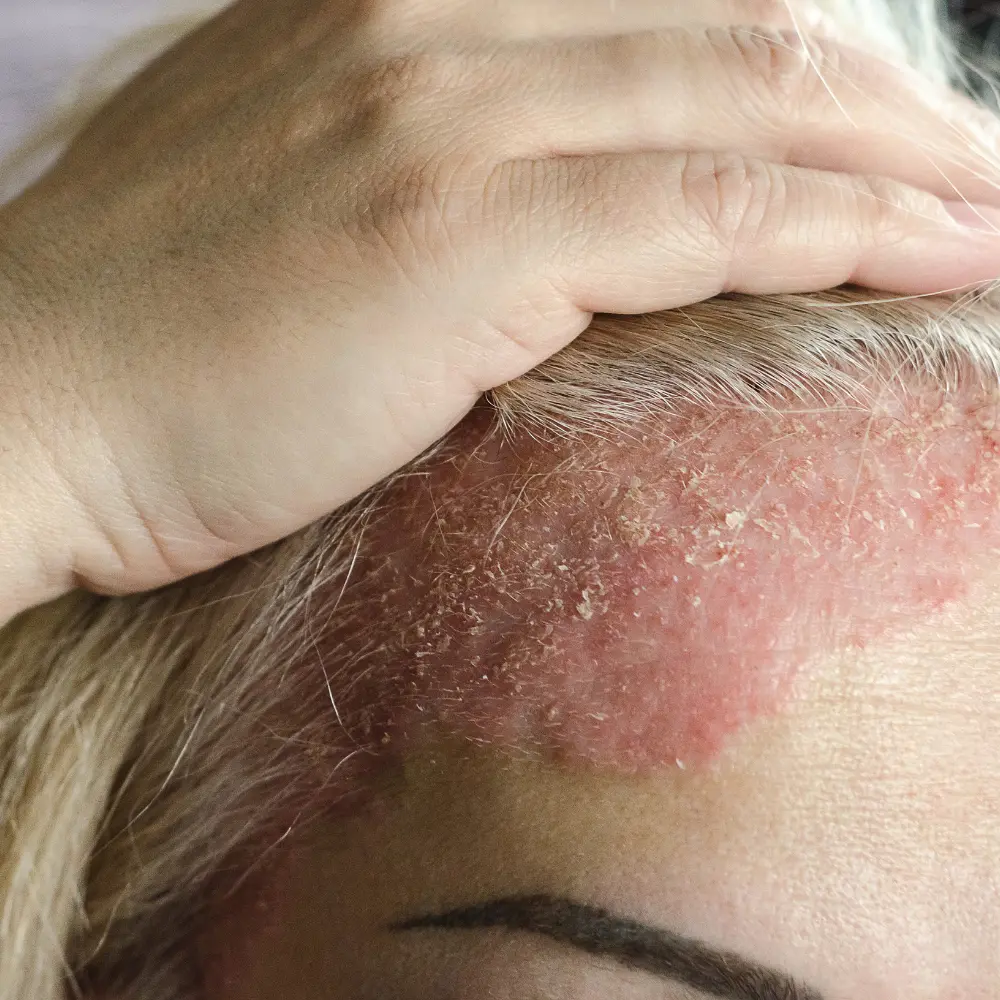 Psoriasis Treatment