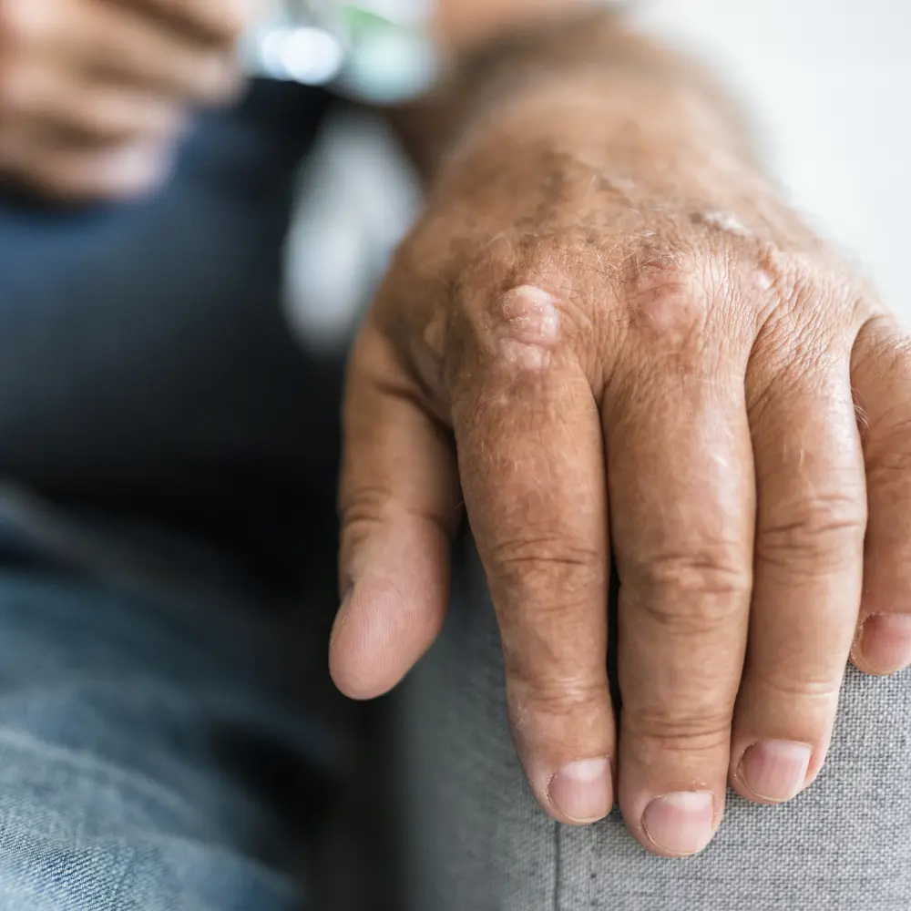 Psoriasis Treatment