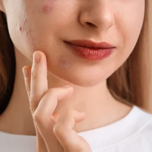 ACNE/Pimple