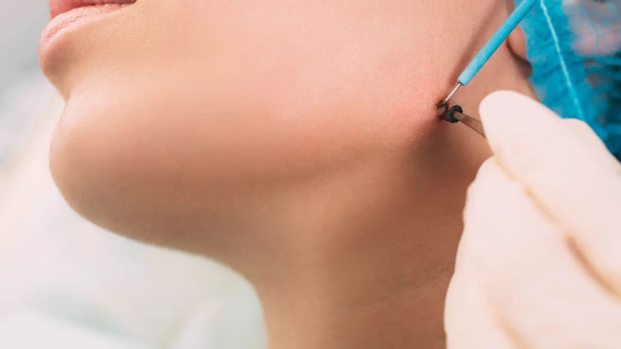 TATTOO/ MOLE REMOVAL