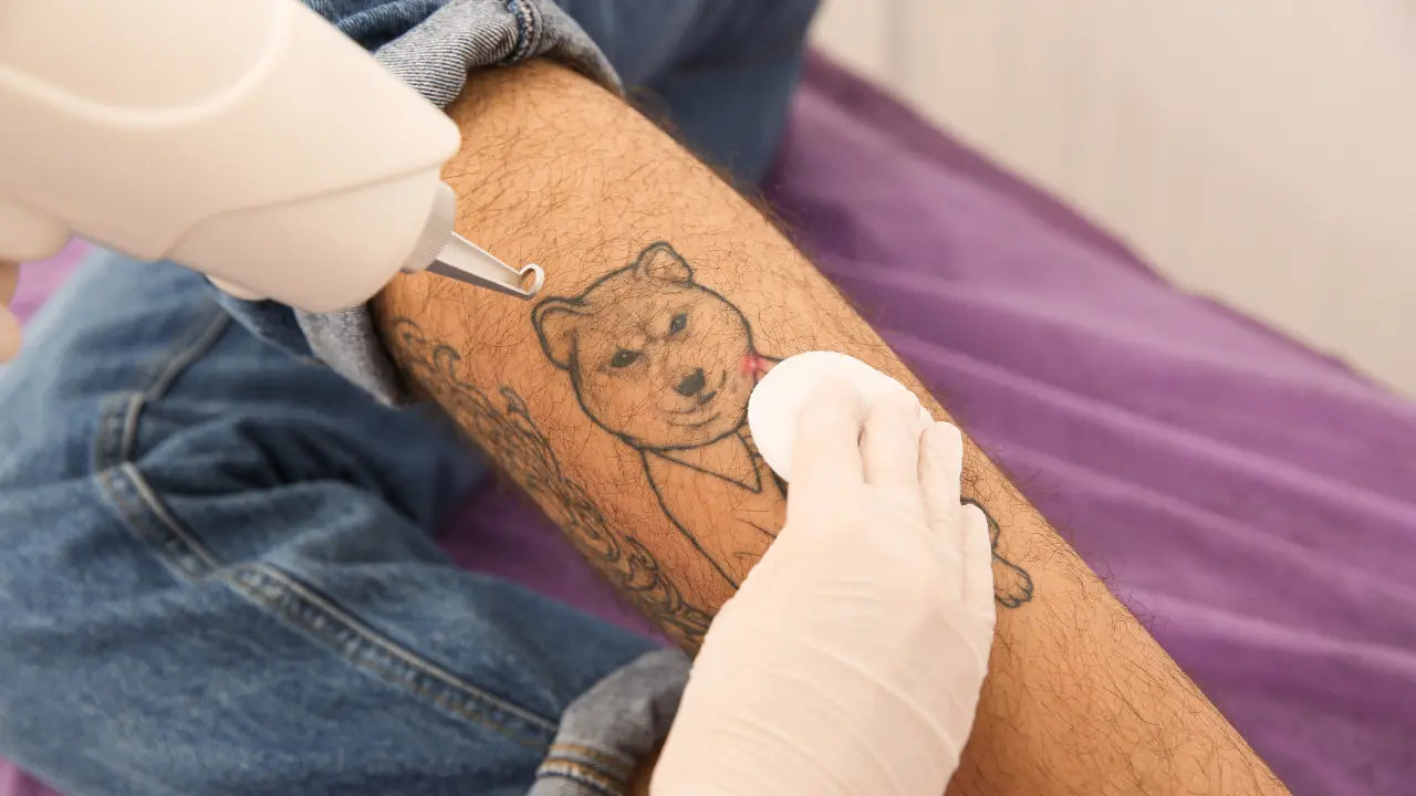 TATTOO/ MOLE REMOVAL
