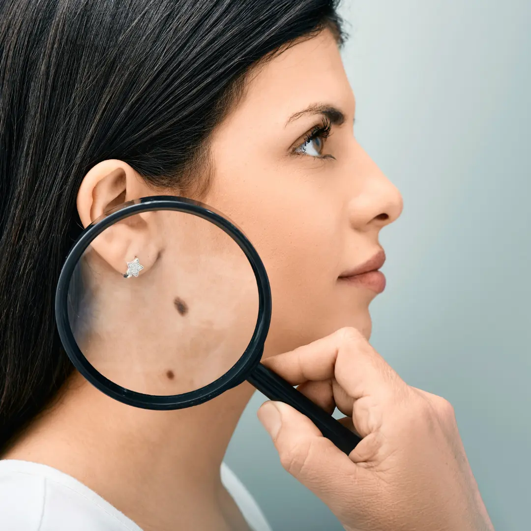 TATTOO/ MOLE REMOVAL