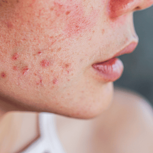 Pimple pigmentation