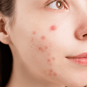 Acne/pimple