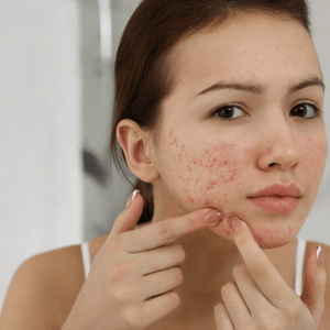 Acne Scar treatment