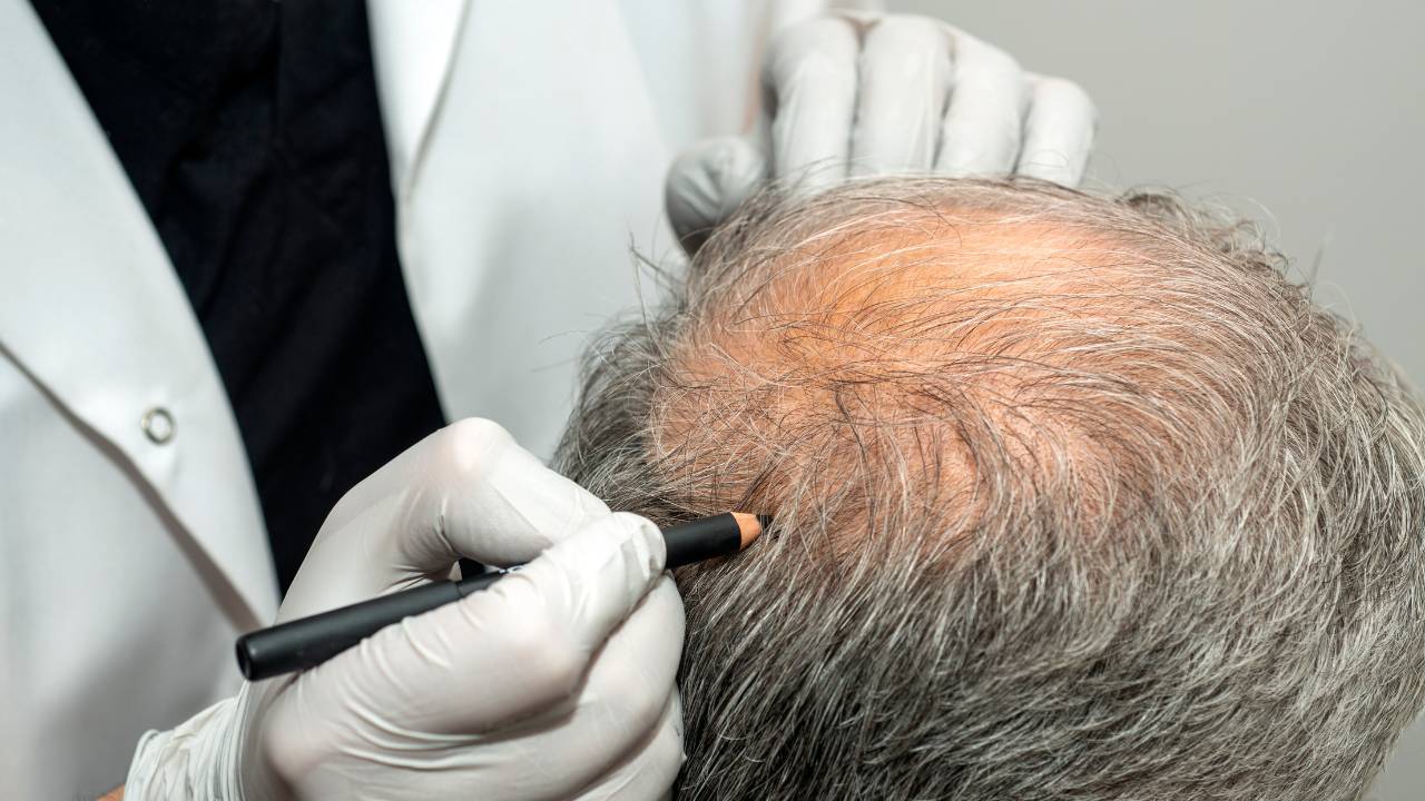 Hair transplant