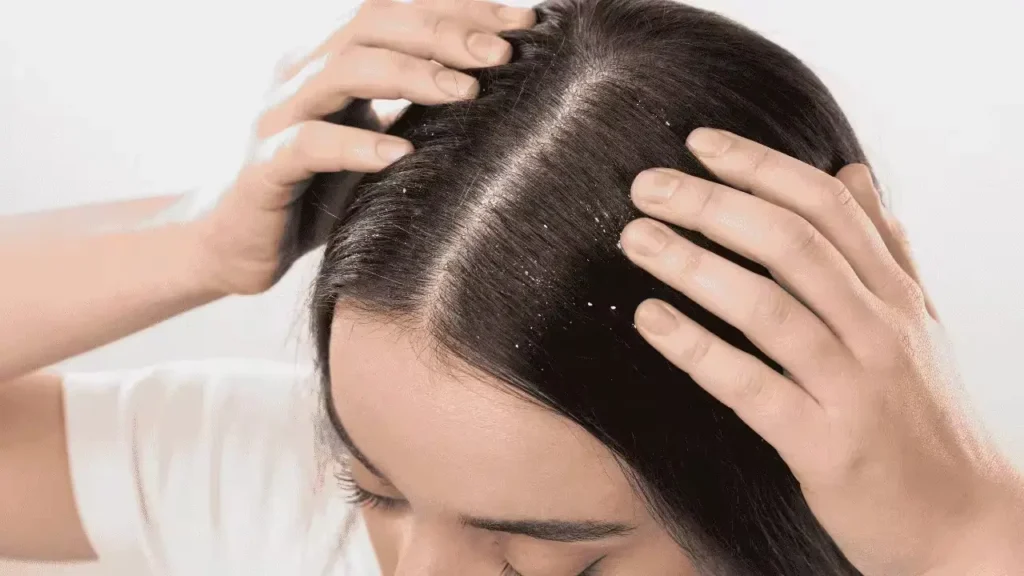 TREATMENT OPTIONS FOR DANDRUFF
