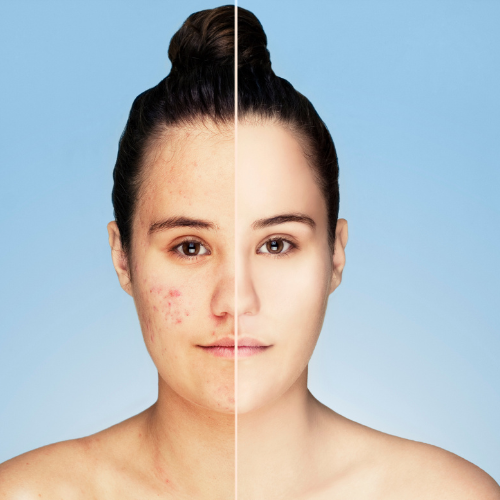 ACNE/Pimple
