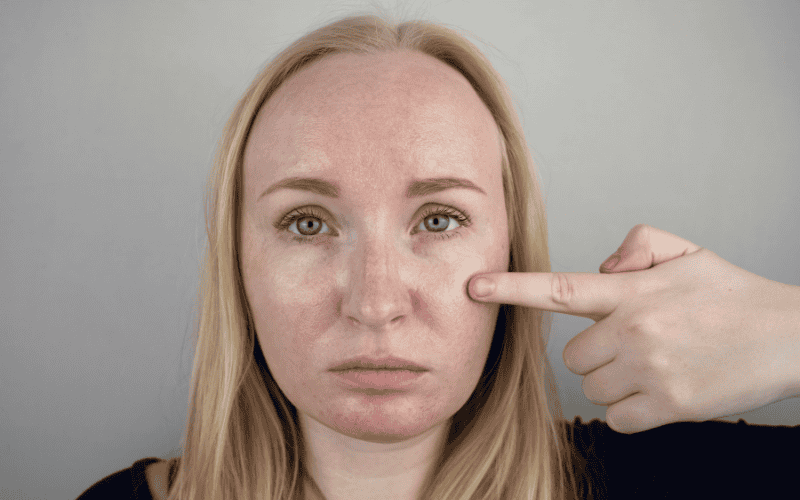 Pigmentation Treatment