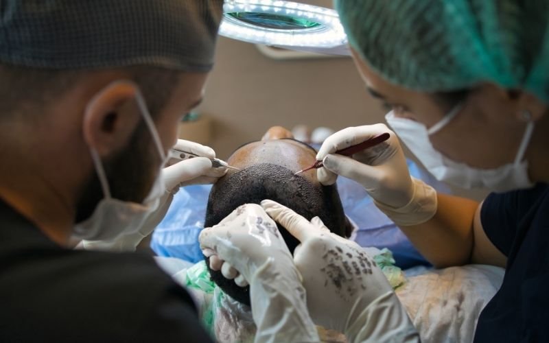 hair transplant