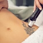 Tattoo Removal untitled design (3)