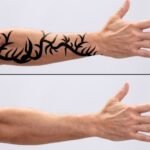 Tattoo Removal untitled design (4)