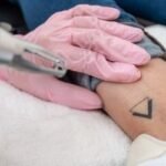 Tattoo Removal tattoo removal