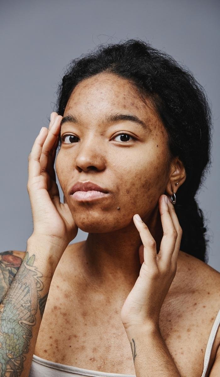 Pigmentation Treatment