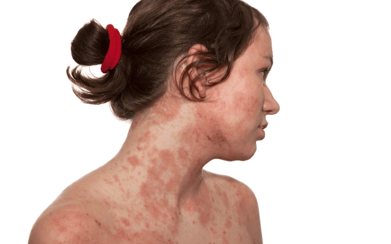 eczema