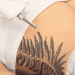 Tattoo Removal tattoo removal