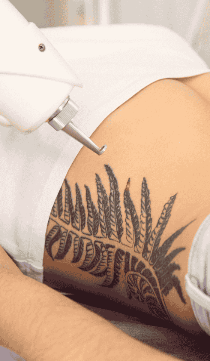 tattoo removal