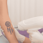 Tattoo Removal untitled design (92)