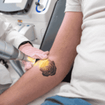 Tattoo Removal tattoo removal