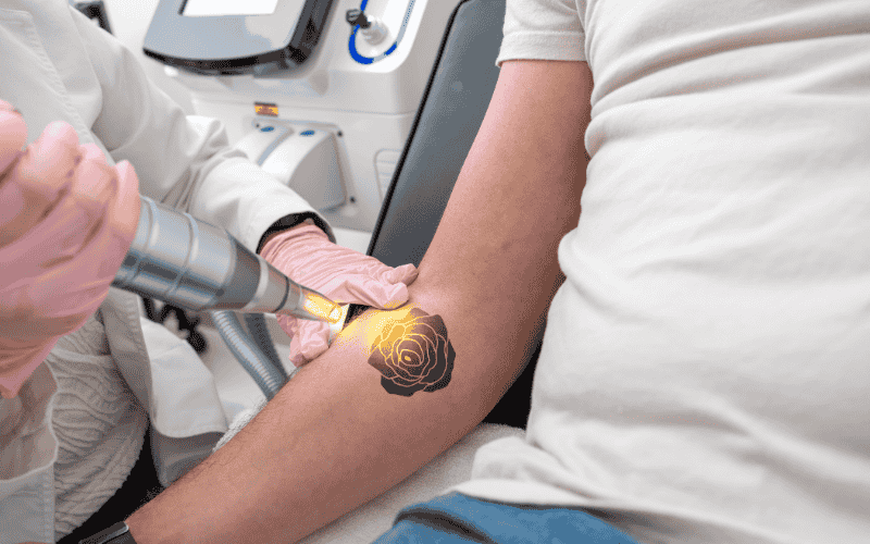 tattoo removal