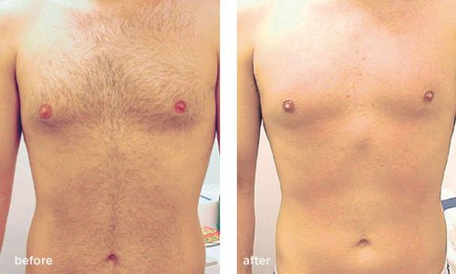 laser hair removal before after men2