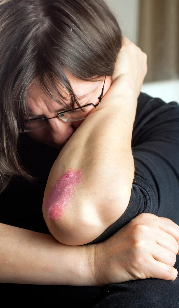 Psoriasis Treatment in Ahmedabad