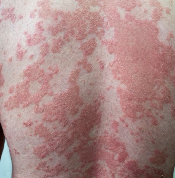 psoriasis