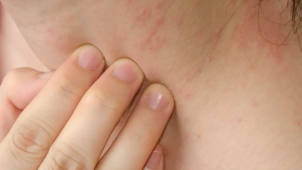 Soft-Pink-Closed-Minded-VS-Open- (7) Eczema treatment